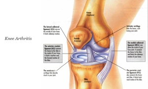 Knee-Arthritis